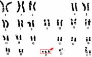 350px-21_trisomy_-_Down_syndrome.png