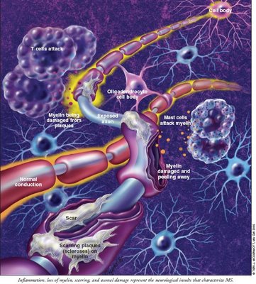 Esclerosis m�ltiple
